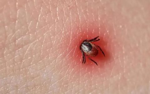 蜱虫怎么消灭?发现蜱虫叮咬后怎么办