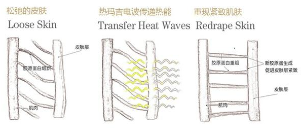 热玛吉的原理和功效，哪些人群适合热玛吉治疗？