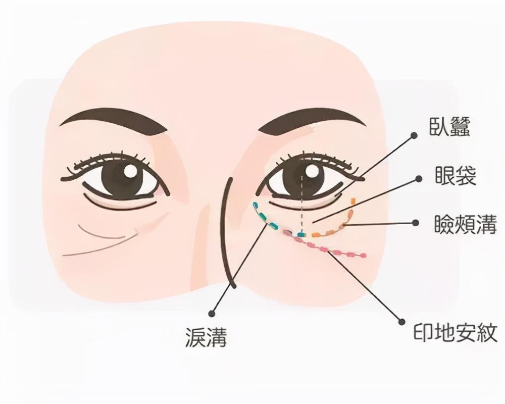 印第安纹是哪个部位？印第安纹怎么消除